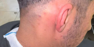 Gast heeft een ingegroeide haar van 3 jaar